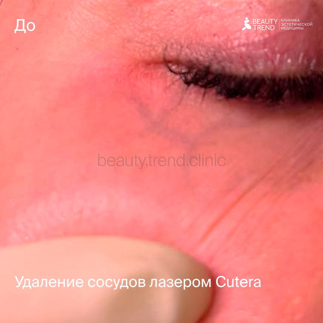 Удаление сосудов Cutera - до 1